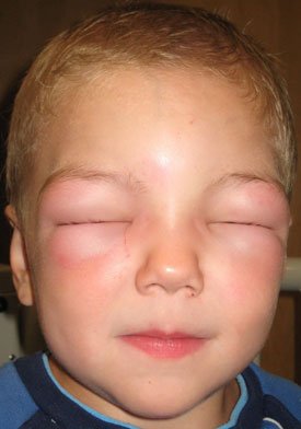 Аллергия — симптомы, причины и лечение аллергии
